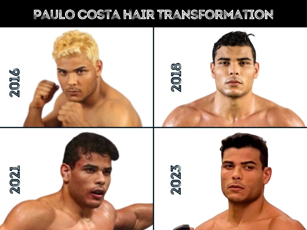 Paulo.Costa Hair Transplant: The Ultimate Solution for Hair Loss?