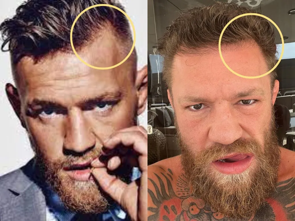 Conor McGregor Hair Loss: Addressing the Rumors, How to Handle Male Pattern Baldness