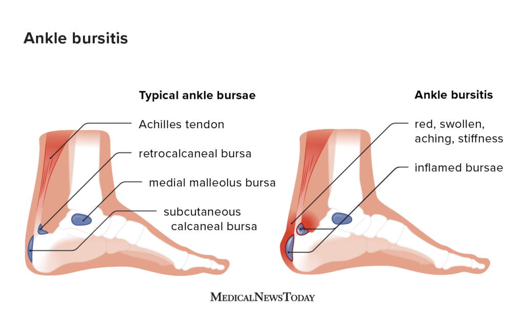 Ankle Bone Pain? Check Out the Latest NYT Coverage.